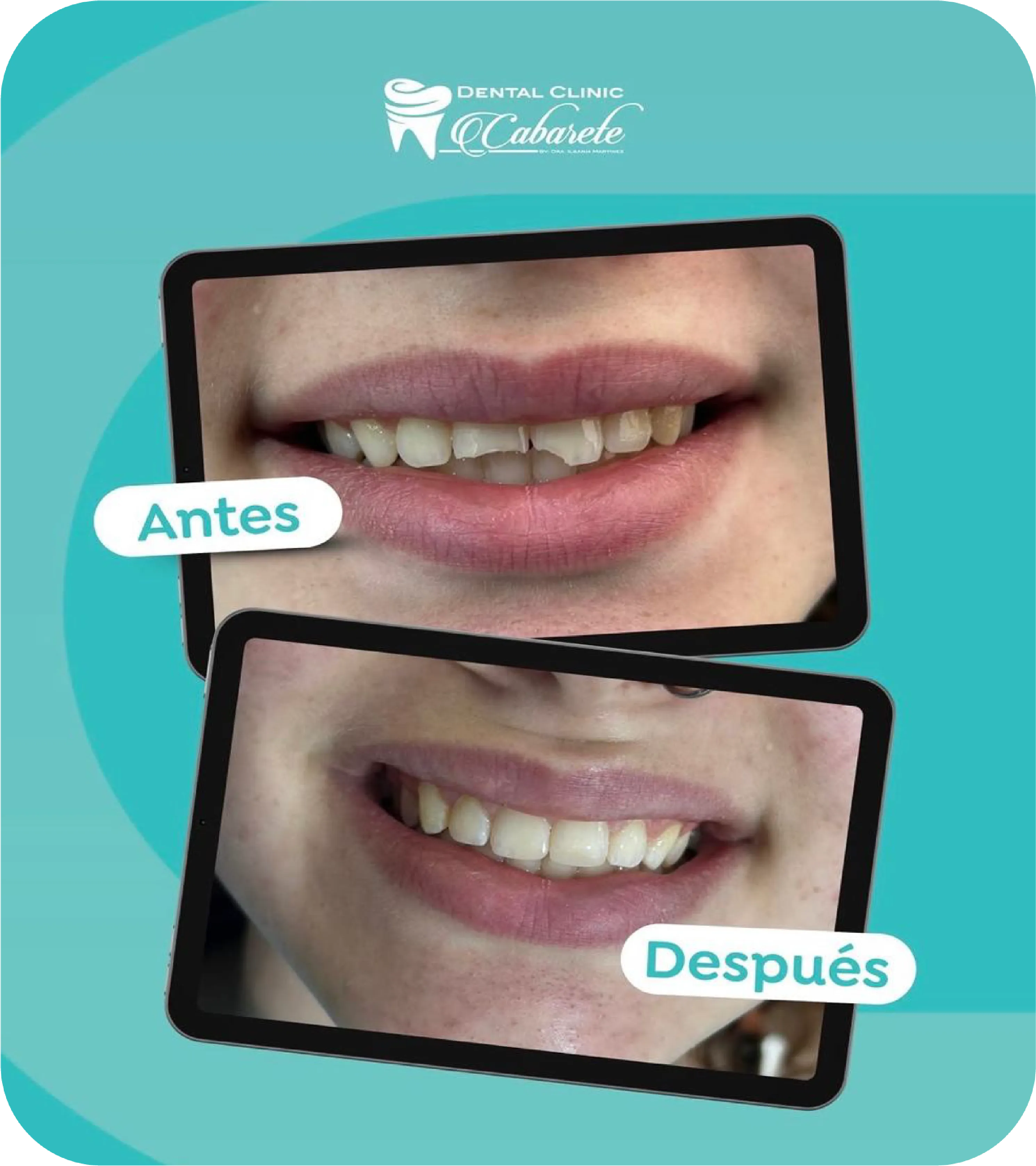 Before and after dental result 2